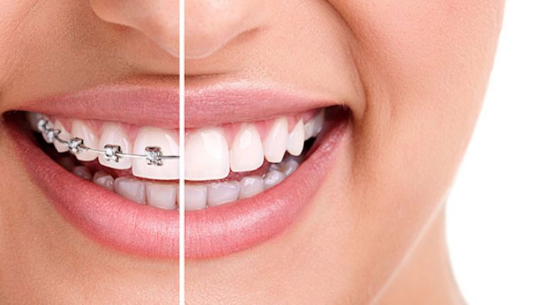 Orthodontic Treatment Price in Ahmedabad