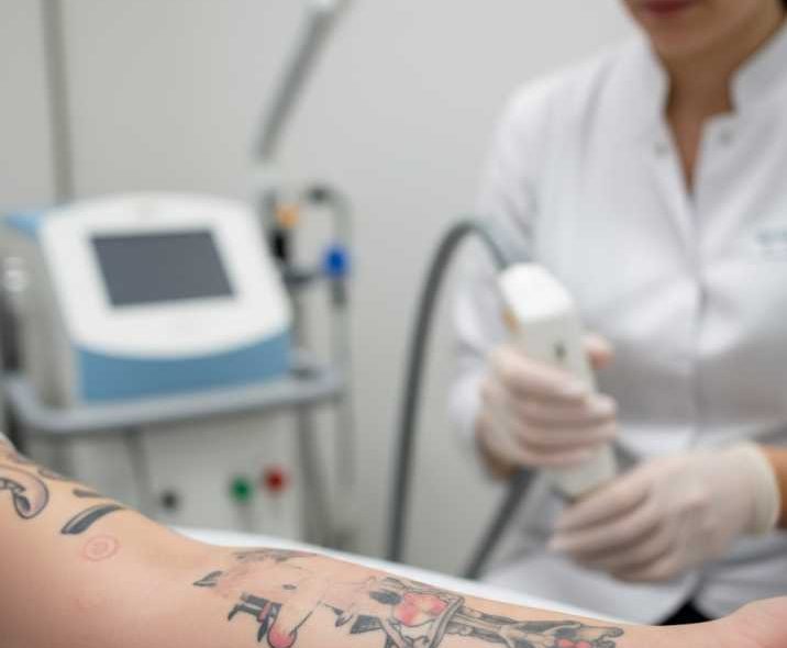Do You Need a Dermatologist for Tattoo Removal